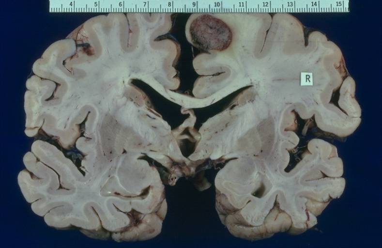 Tumore al cervello